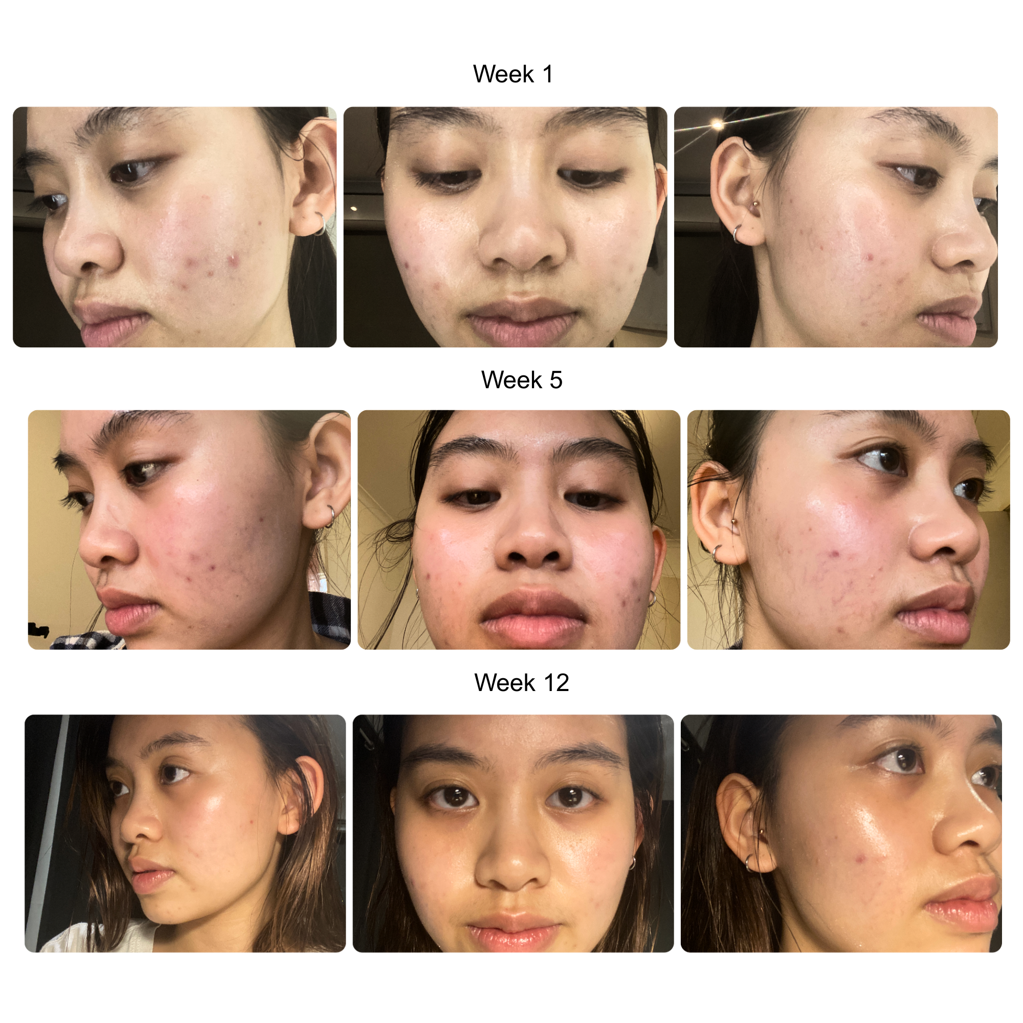 AuraWave acne marks and scars progress results