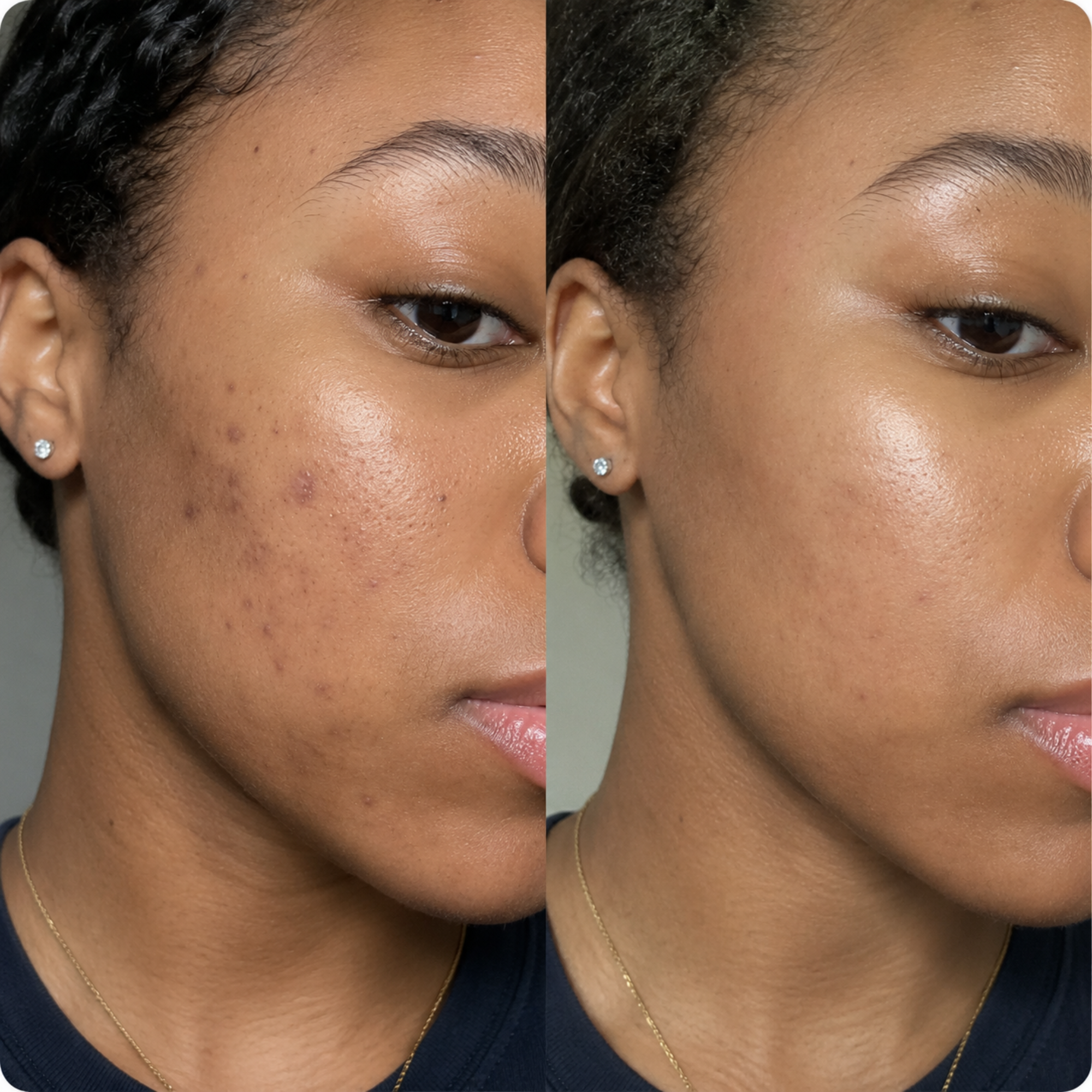 Maya before and after post-acne dark spots